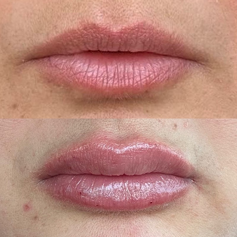 Natural lip filler results
